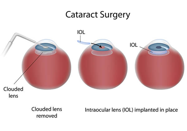 Cataract Surgery Chart