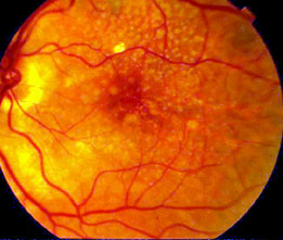 Macular Degeneration in the Eye