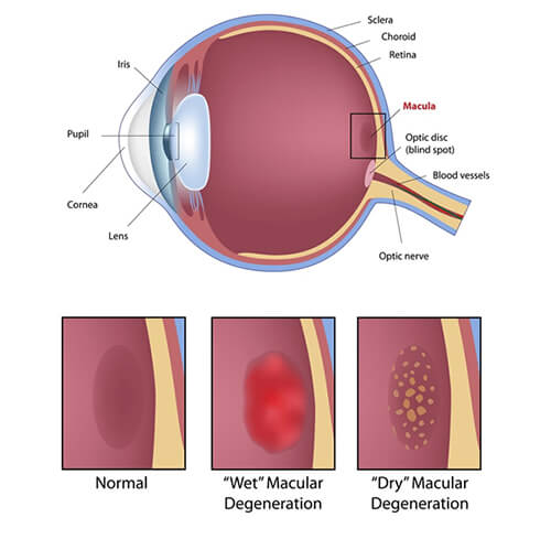 Macular Degeneration Chart