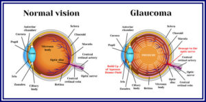 Normal Vision | Glaucoma
